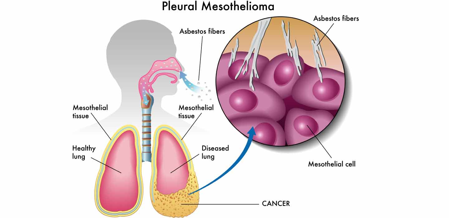 mesothelioma death certificate